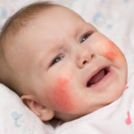 Alergia skórna u niemowląt – jak postępować?
